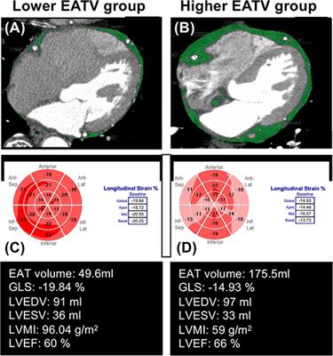 Deleterious Effects of Epicardial Adipose Tissue Volume on Global Longitudinal Strain in Patients With Preserved Left Ventricular Ejection Fraction